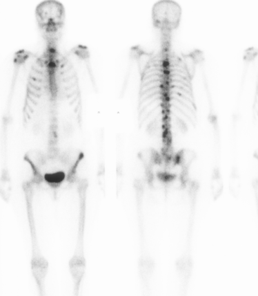 Bone Scan Metastasis